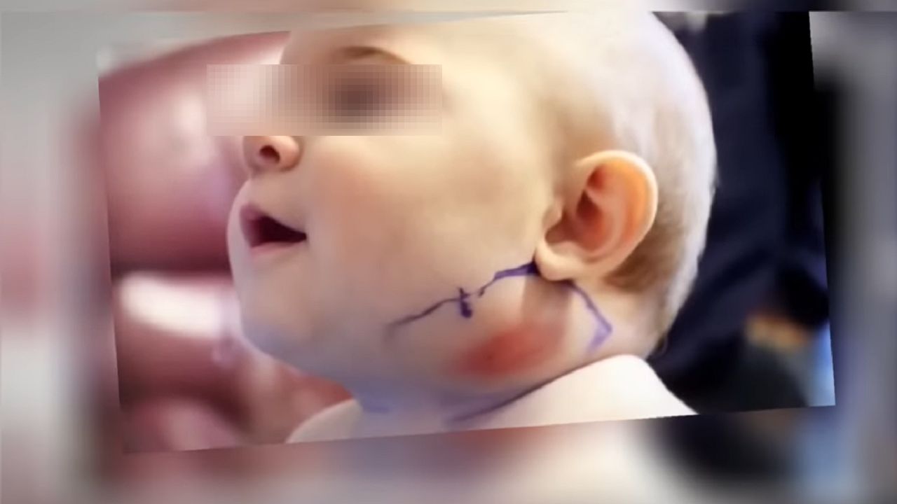 Bizarre Discovery: Baby Girl Hospitalized for Unexplained Neck Swelling